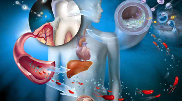Parodontite e malattie cardiovascolari: la relazione pericolosa